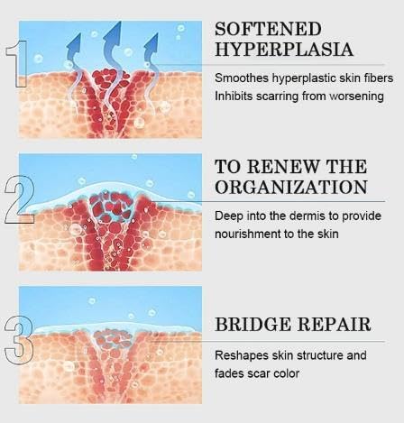 Advanced Scar Cream Gel, Scar Removal