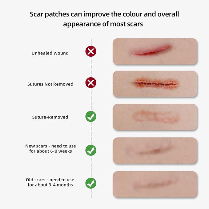 Silicone Scar Sheet, Silicone Scar Tape