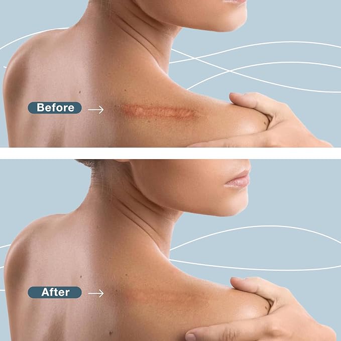 Silicone Scar Sheets, Scar Tape