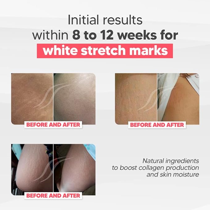 Cicatrissim White Stretch Mark Fade and Removal Cream - Innovative Formula With Pure and Powerful Natural Ingredients From Brazilian Flora - For All Skin Types.