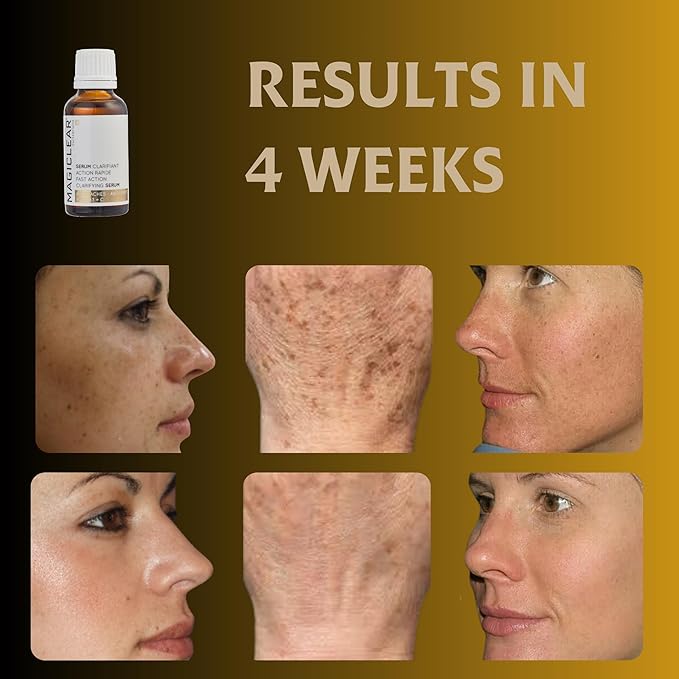 Luxury Swiss Dark Spot Remover for Face and Body Serum Gel Cream Age Sun Brown Spot Acne Freckles Corrector Melasma treatment Anti aging Skin Vitamin C + Niacinamide best organic brand Magiclear