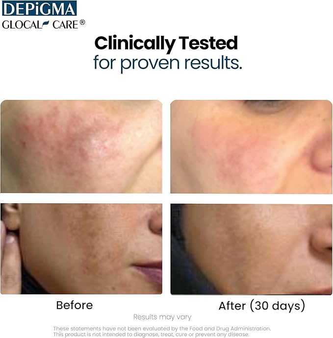 GlocalCare Depigma Support Reduction of Hyperpigmentation, Melasma & Dark Spots with Glutathione, Polypodium Leucotomos, Grape Seed & Marigold Extract