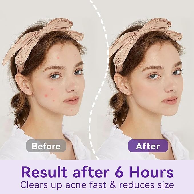 Overnight Pimple Patches for Face - Maximum Strength Hydrocolloid for Cystic Acne & Dark Spots (72 Count) - 10mm & 12mm Medicated Night Time Treatment