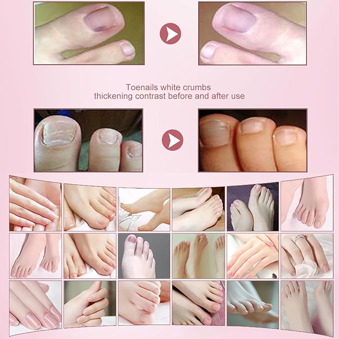 2pcs Herbal Nail Treatment Essence,Rosabelle