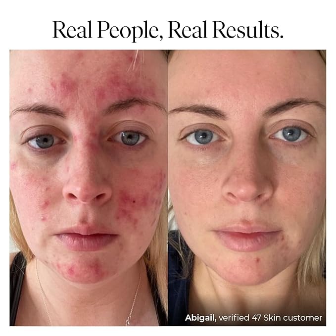 | Hydrating Face Serum with Silver Chitoderm for ALL Skin Types | Clears Acne, Prevents & Heals Breakouts & Blemishes, Repairs Scars | Moisturises and Nourishes For Smooth Skin | 30ml