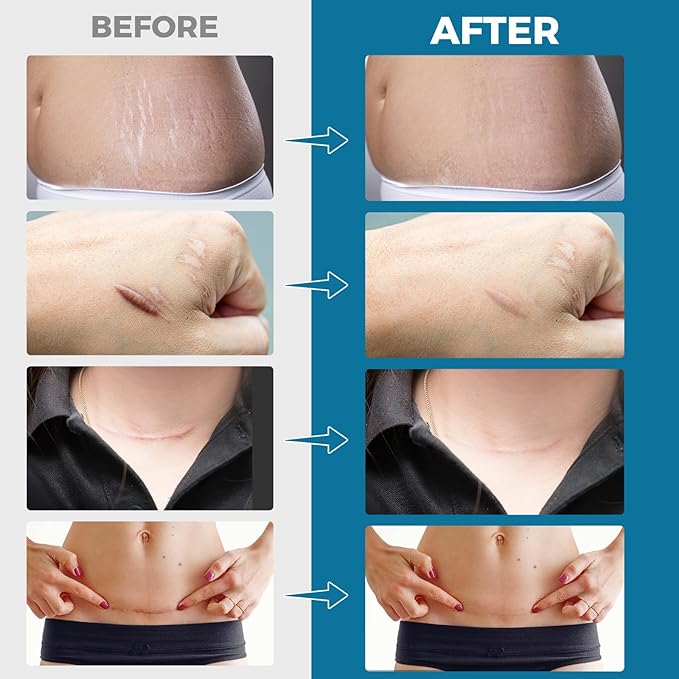 Scar Away Silicone Scar Sheets, Silicone