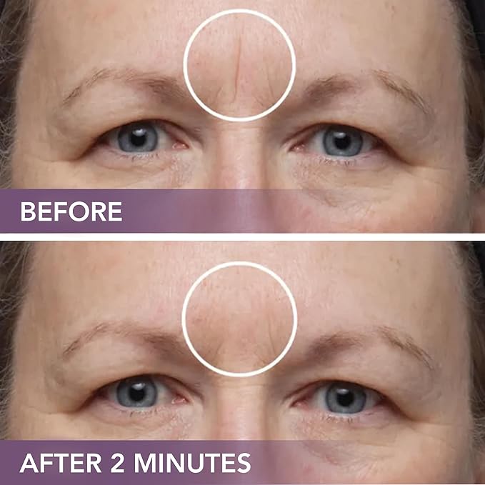 Dermaflage Scar Filler Kit - Bronze Medium - Deep Scar Cover and Waterproof Concealer for Acne Scars Wrinkles, and Ice Pick Scars Makeup, 1 mo supply