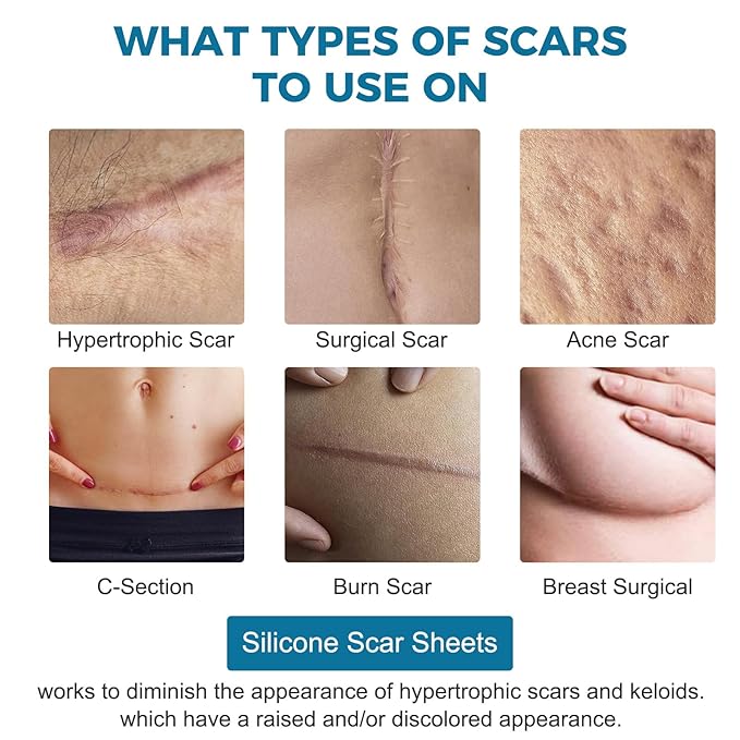 Scar Away Silicone Scar Sheets, Silicone