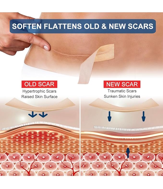 Medical Grade Silicone Scar Sheets, Silicone