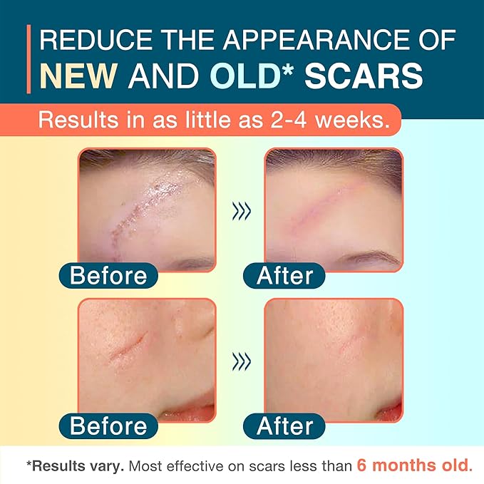 Silicone Scar Sheets, 1.5¡± x 78¡±