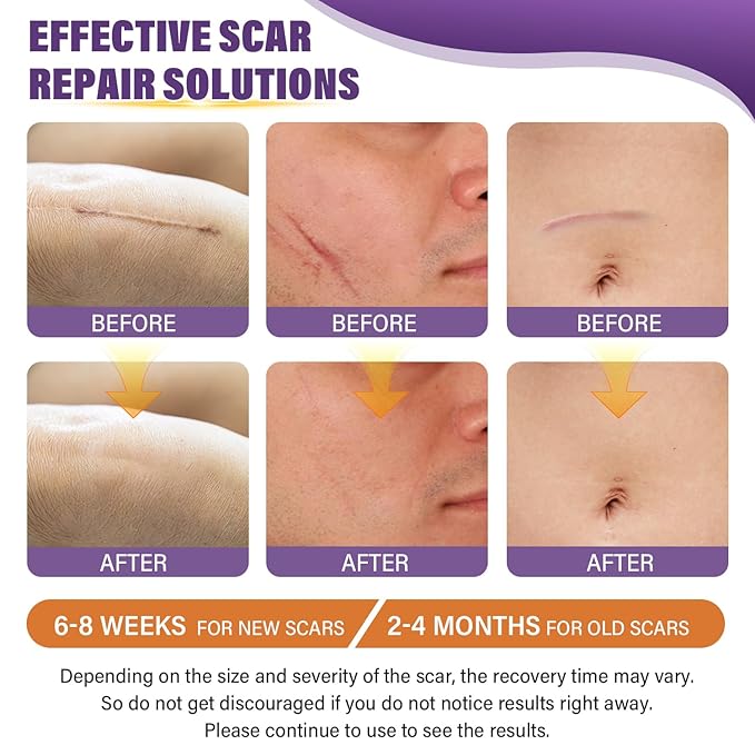 Silicone Scar Sheets,Silicone Scar Tape,Scar Tape