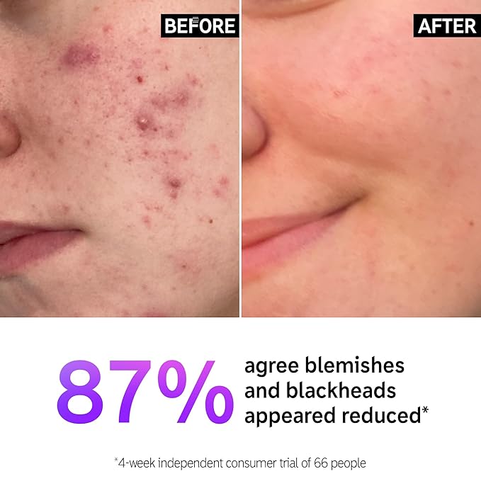 The INKEY List Salicylic Acid Cleanser, Face Wash for Blemishes, Blackheads, Oily Skin and Breakouts, Non-Drying Facial Cleanser Safe for All Skin Types, 5.0 fl oz