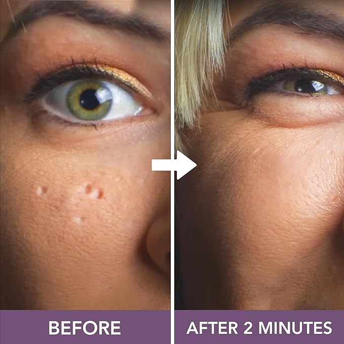 Dermaflage Scar Filler Kit - Dark - Deep Scar Cover and Waterproof Concealer for Acne Scars Wrinkles, and Ice Pick Scars Makeup, 1 mo supply