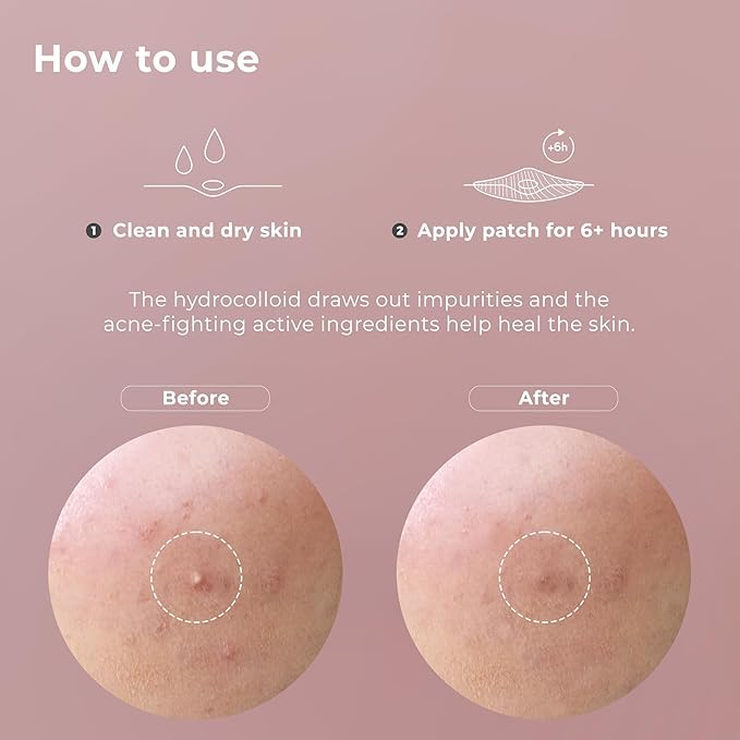 OMMA Korean Pimple Patches for Face with Hydrocolloid Patch, Invisible Blemish Pimple Stickers Acne Dots - Salicylic Acid Whiteheads Fast Acne Spot Treatment - 10 mm Zit Patches (72 Count)