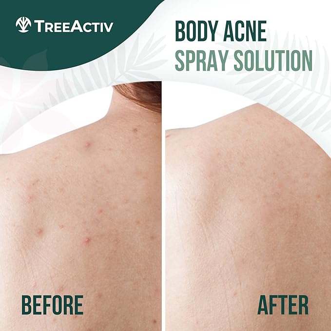 Salicylic Acid Back & Body Acne Spray, Back Acne Solution For Women And Men, Acne Body Spray with Tea Tree Oil, Fast-Drying Back Acne Spray, Fine Mist, Back Acne Treatment Spray, 4 fl oz, 2-pack