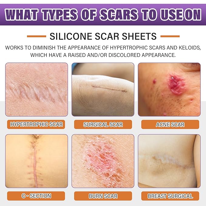 Silicone Scar Sheets,Silicone Scar Tape,Scar Tape